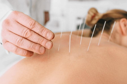 Acupuntura