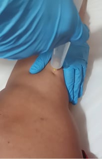 Ozonioterapia