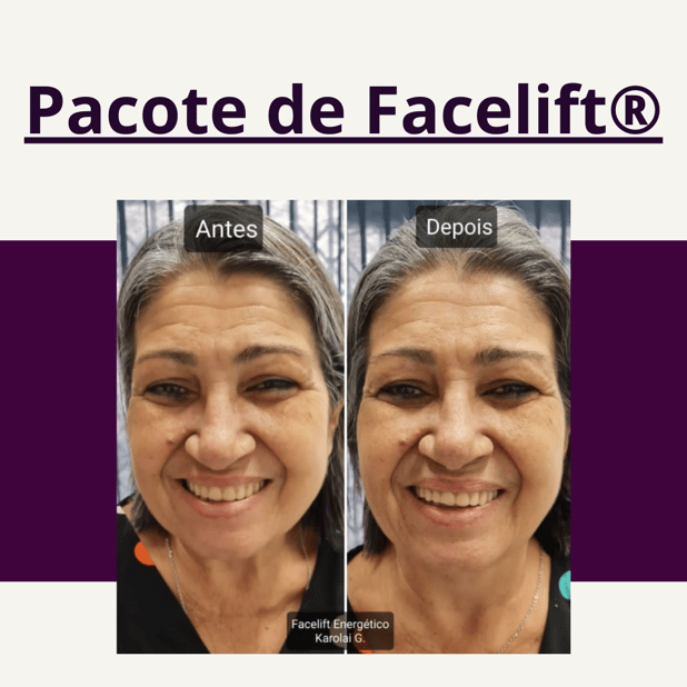 Pacote de 5 Sessões de Barras de Access