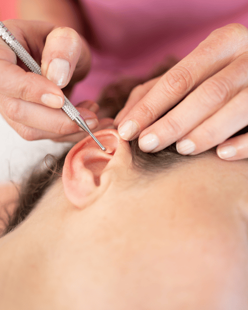 Auriculoterapia