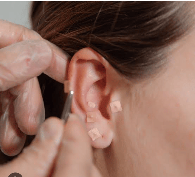 Auriculoterapia