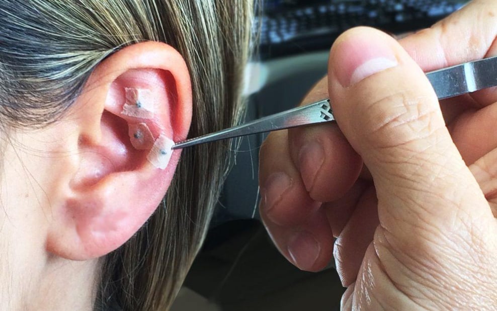 1 Sessão de Auriculoterapia