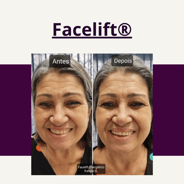 Sessão de Facelift®
