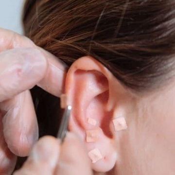 Sessão de Auriculoterapia