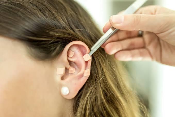 Terapia Auriculoterapia