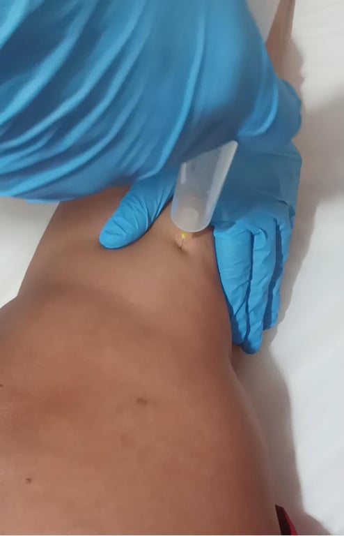 Ozonioterapia